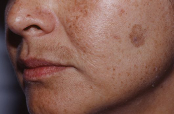 Melasma-02